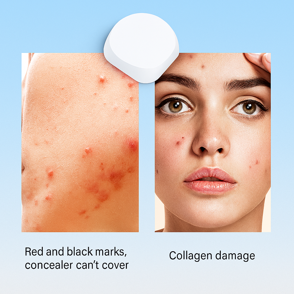DermaDot™ - LED Light Therapy Pimple Patch