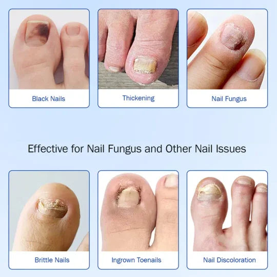 Fungal Nail Patches, 21 Pcs