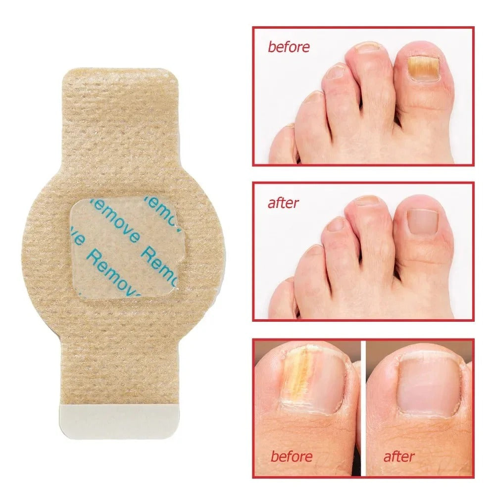 Fungal Nail Patches, 21 Pcs