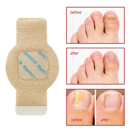Fungal Nail Patches, 21 Pcs